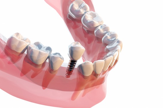 インプラントとの違い