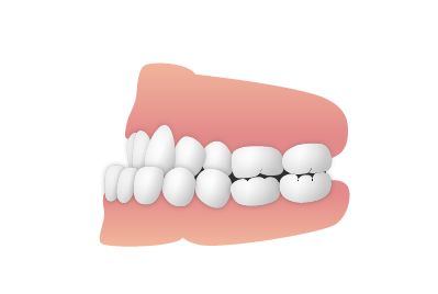 受け口（反対咬合）のイメージ