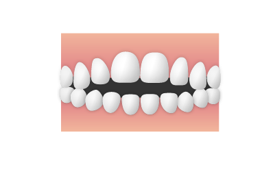 開咬（オープンバイト）のイメージ