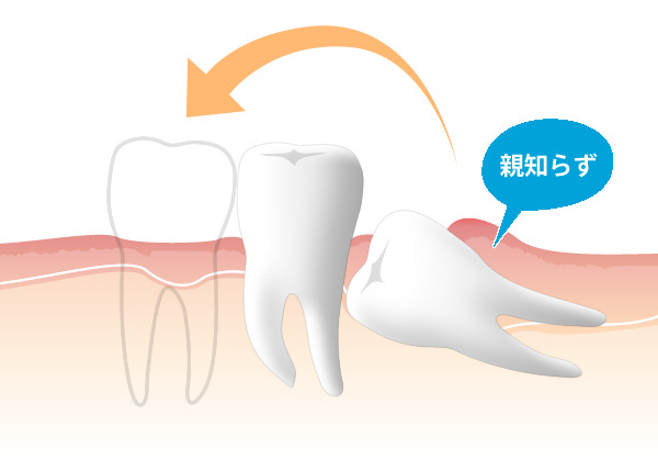 自家歯牙移植（歯の移植）とは？自分の歯を活かす「第3の選択肢」