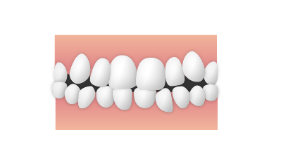 ガタガタ・八重歯（叢生）のイメージ