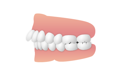 出っ歯（上顎前突）のイメージ