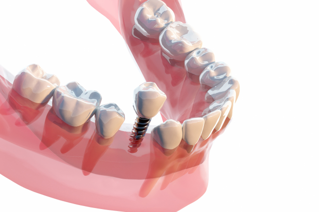 【徹底比較】自家歯牙移植とインプラントの違い