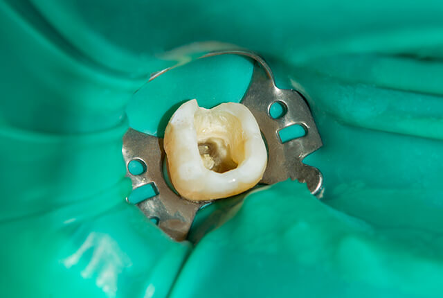 ラバーダム防湿